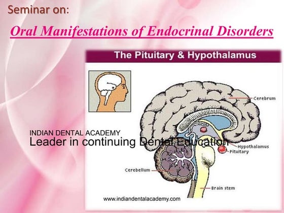  Oral Manifestations of Endocrinal Disorders / dental crown & bridge courses