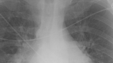 Heart Failure & Hypercholesterolemia: Case Based Discussion Heart Failure & Hypercholesterolemia: Case Based Discussion