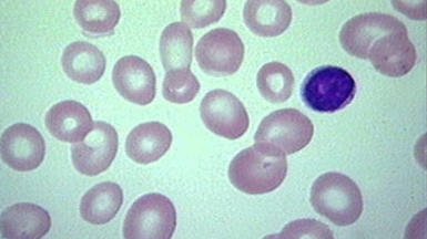 Megaloblastic Anemia : Intro, Clinical Features & Management Megaloblastic Anemia : Intro, Clinical Features & Management