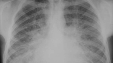 Congestive Cardiac Failure : A Case based Discussion Congestive Cardiac Failure : A Case based Discussion