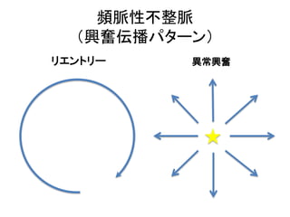 頻脈性不整脈
（興奮伝播パターン）
リエントリー 異常興奮
 