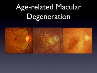 Age-related Macular
  Degeneration
 