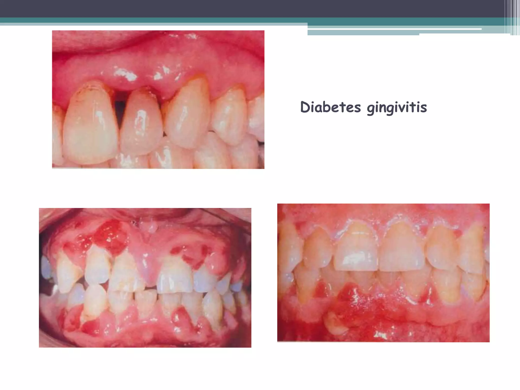 Diabetes gingivitis
 