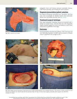 245
Chest wall tumors
malignant chest wall lesions represent metastatic disease,
with breast and lung cancers being the most